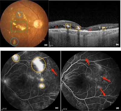 Aflibercept 5+PRN with retinal laser photocoagulation is more effective than retinal laser photocoagulation alone and aflibercept 3+PRN with retinal laser photocoagulation in patients with high-risk proliferative diabetic retinopathy and diabetic macular edema: a 12-month clinical trial